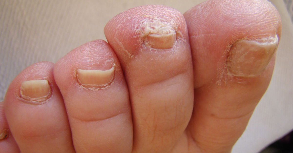 hogyan lehet gyorsan, hogy a gomba a köröm nail gombák indítása stage tünetei